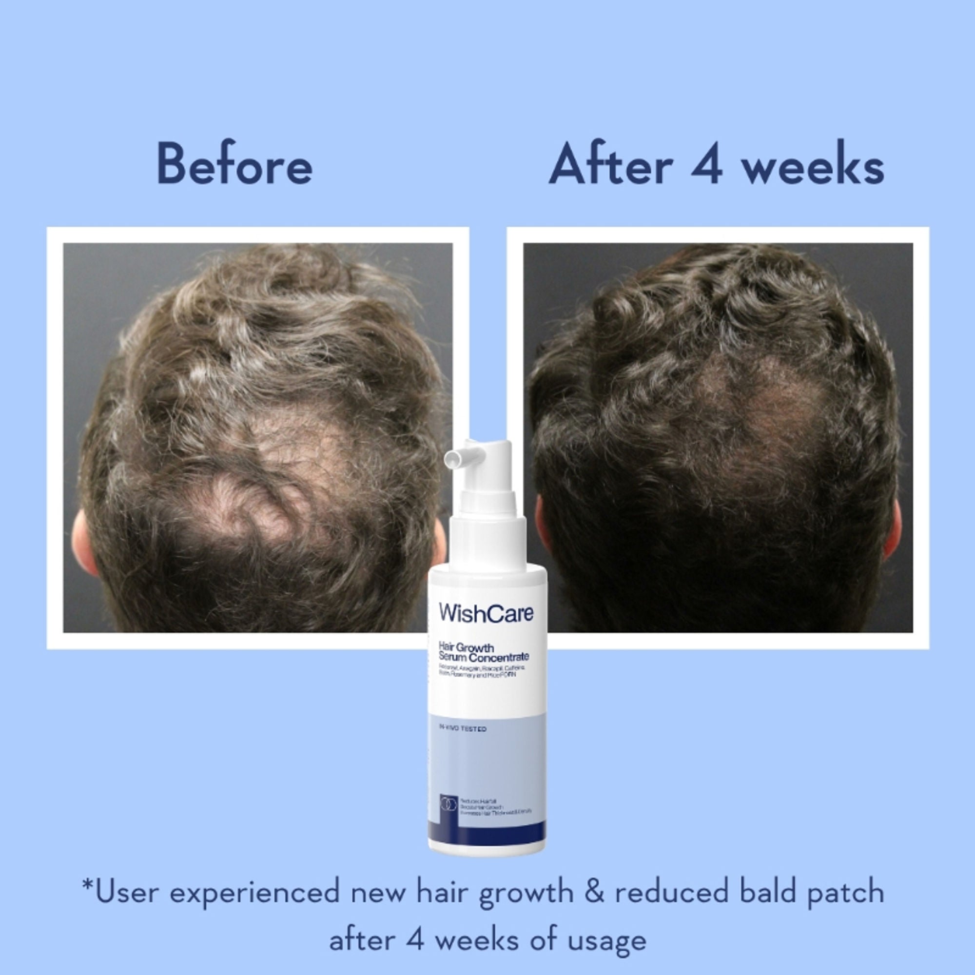 WishCare Hair Growth Serum Concentrate with Redensyl & Rosemary-In-Vivo Tested-Controls Hairfall