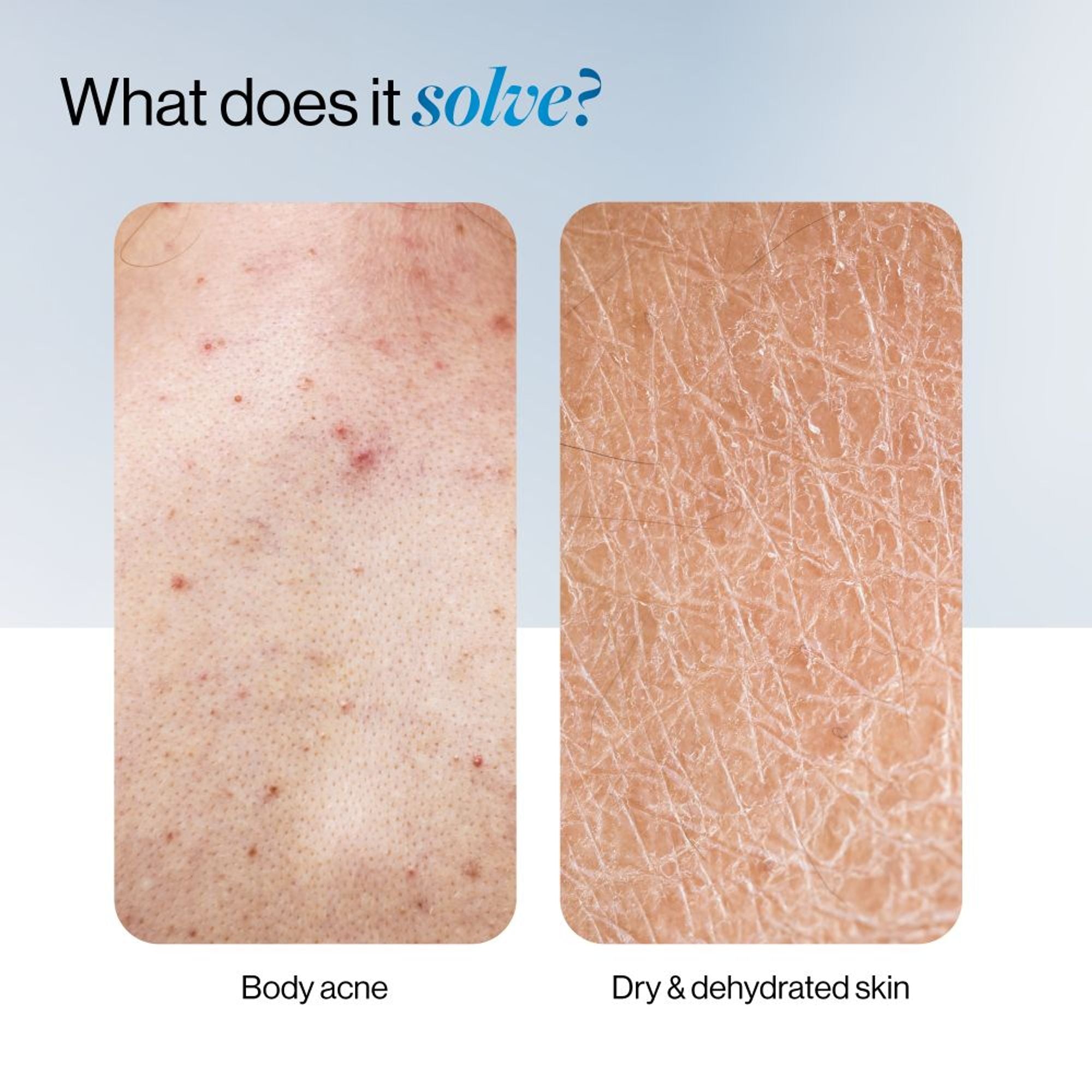 BeBodywise 1% Salicylic Ceramide Body Wash - Dual Pump 2in1 Body Wash - For Body Acne and Dry Skin