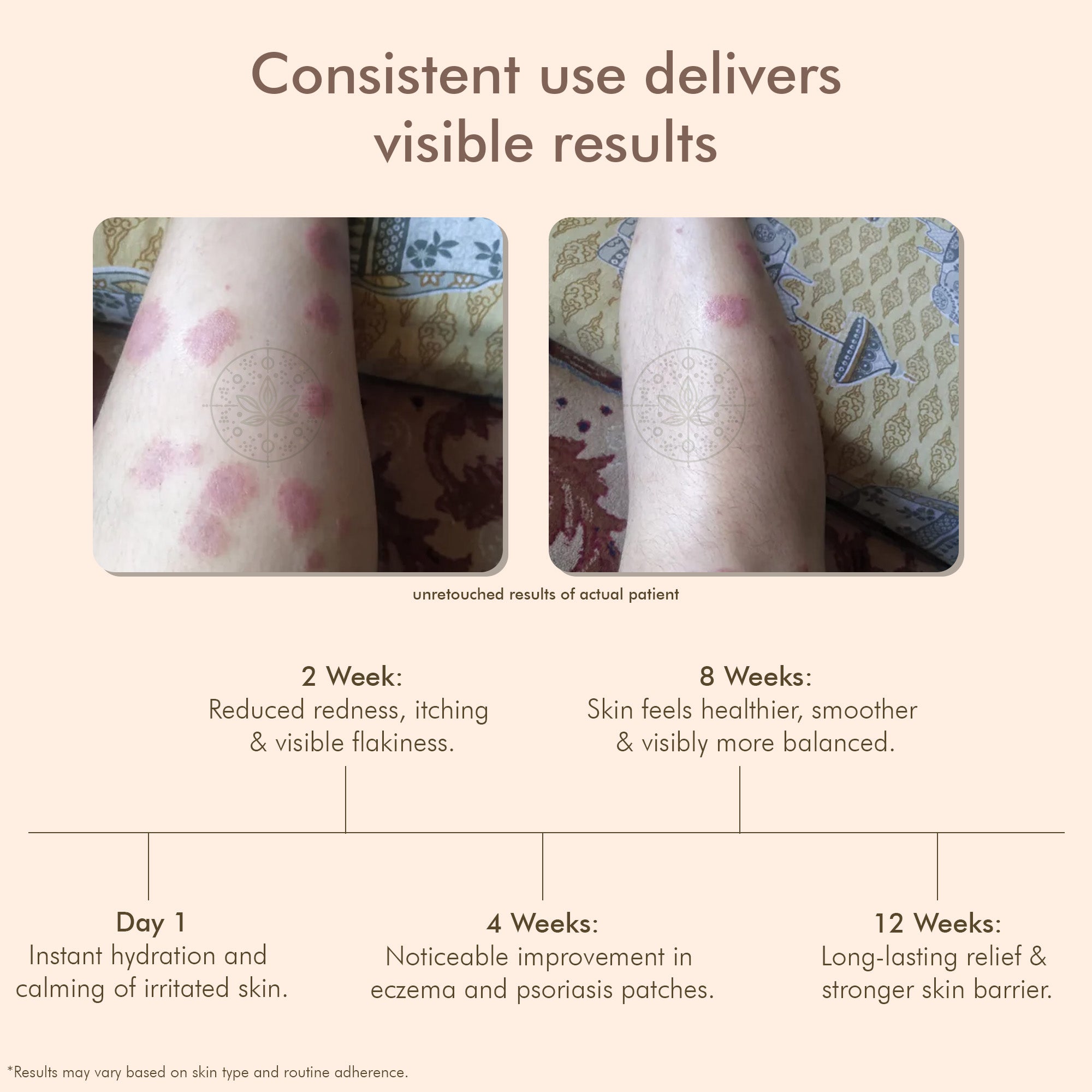 VedicDerm Oleander's Oil for Psoriasis, Eczema, and Atopic Dermatitis