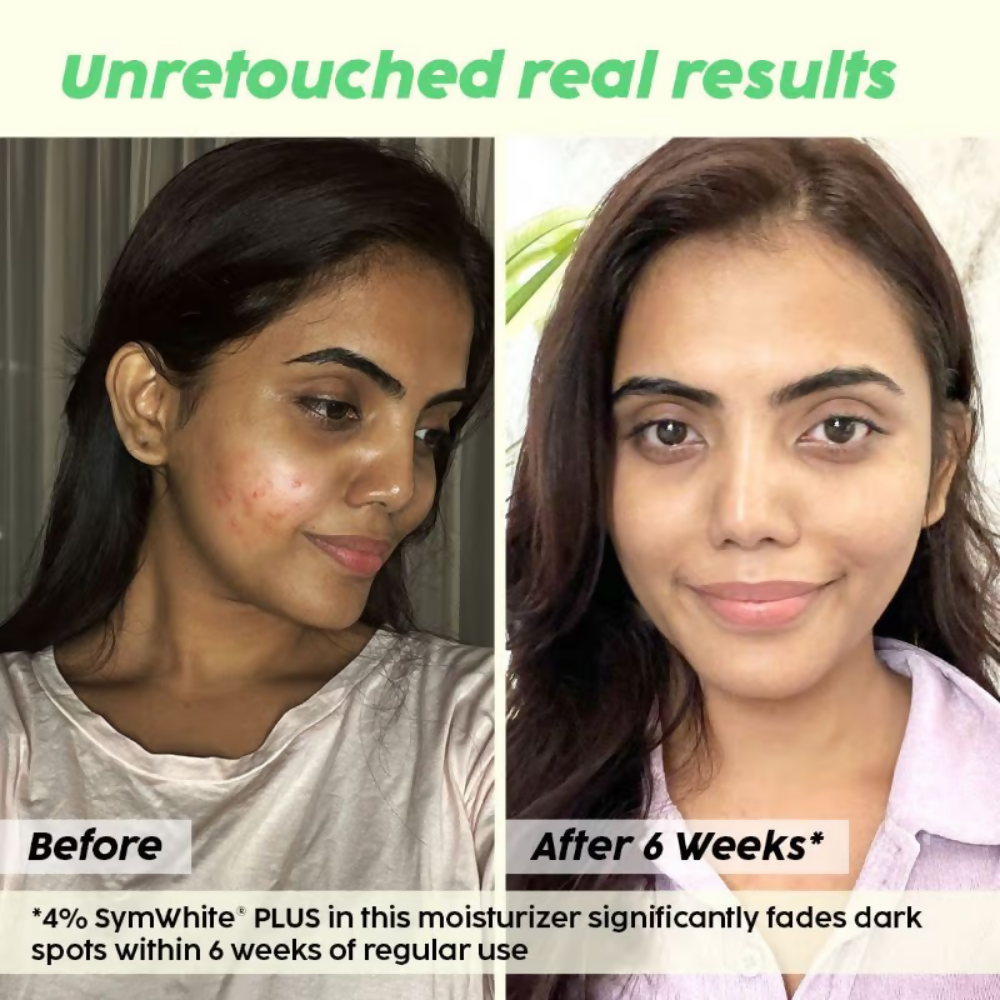 PLIX The Plant Fix 2% Alpha Arbutin Pineapple Moisturizer With SymWhite PLUS For Hyperpigmentation & Dark Spots
