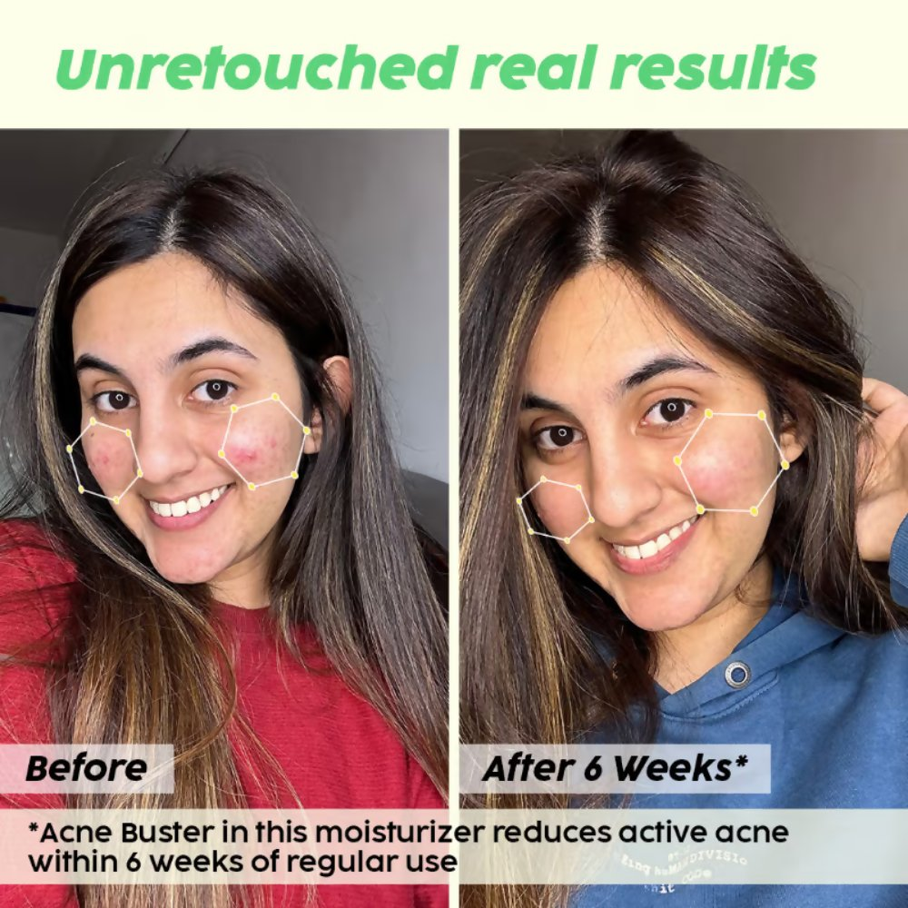 PLIX The Plant Fix 2% Salicylic Acid Active Acne Control Serum & Acne Buster Moisturizer Combo