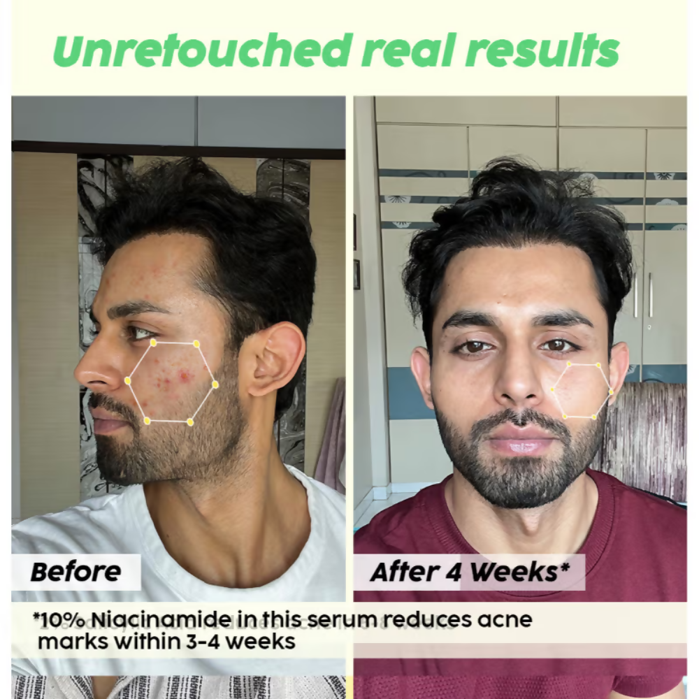 PLIX The Plant Fix 2% Acne Buster Moisturizer & 10% Niacinamide Serum