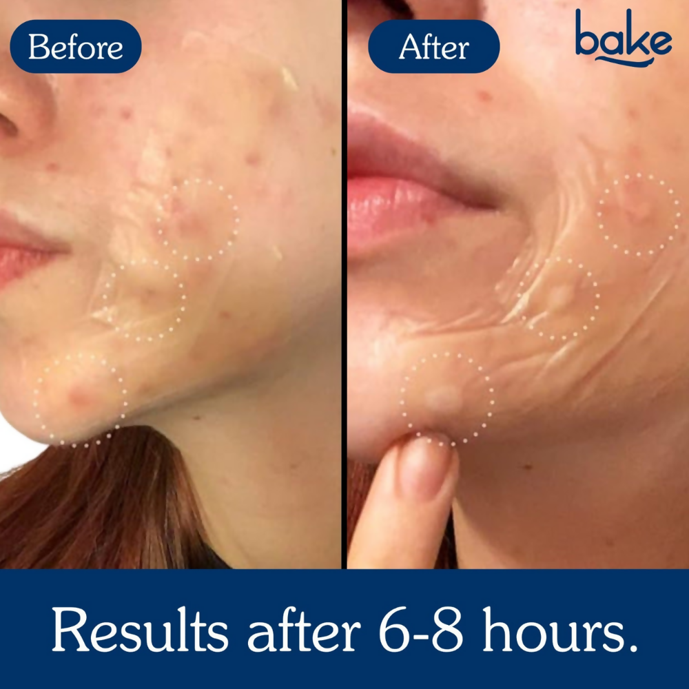 Bake Acne Erase XL Pimple Patches & Nose Patches