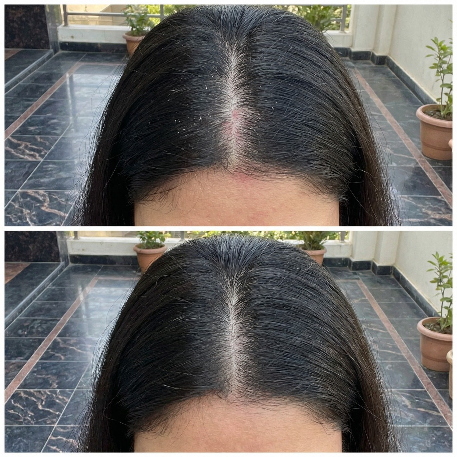Vedicderm Psoriasis Oil 2-in-1 Skin + Scalp Relief Oil