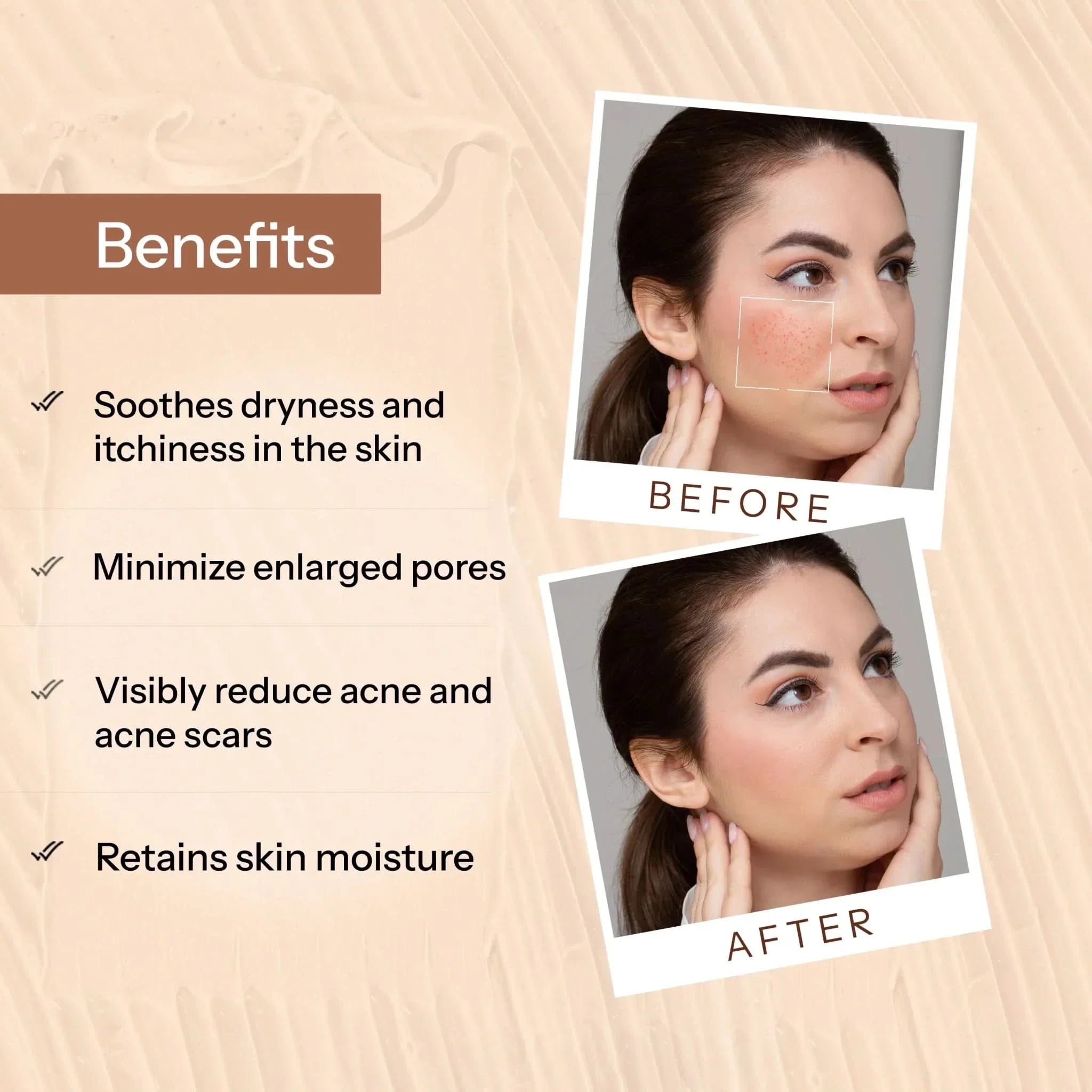 Glopetra Acne Scars & Pits Removal Gel