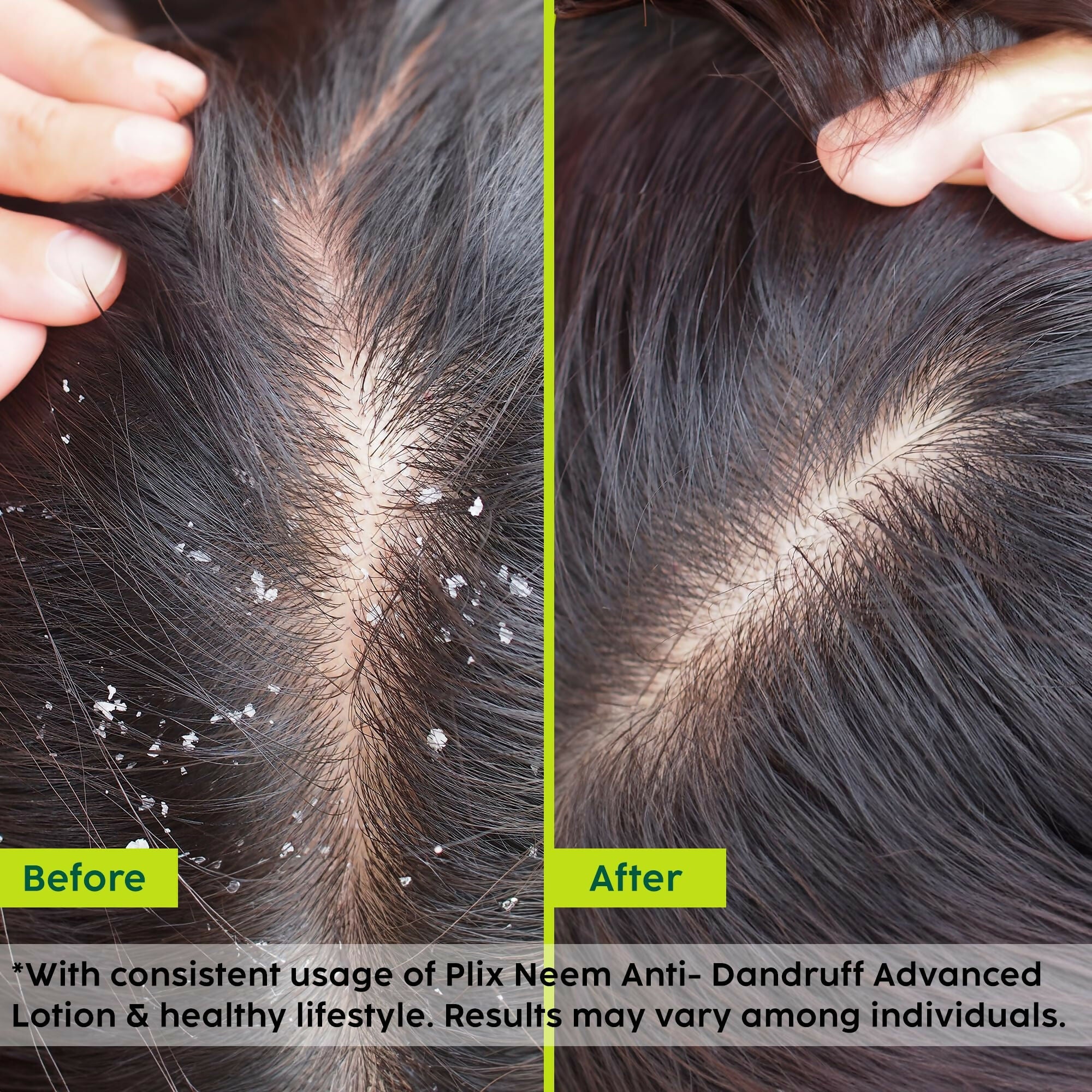 PLIX The Plant Fix Neem Anti-Dandruff Advanced Lotion Reduce Dandruff, Itching & Irritation