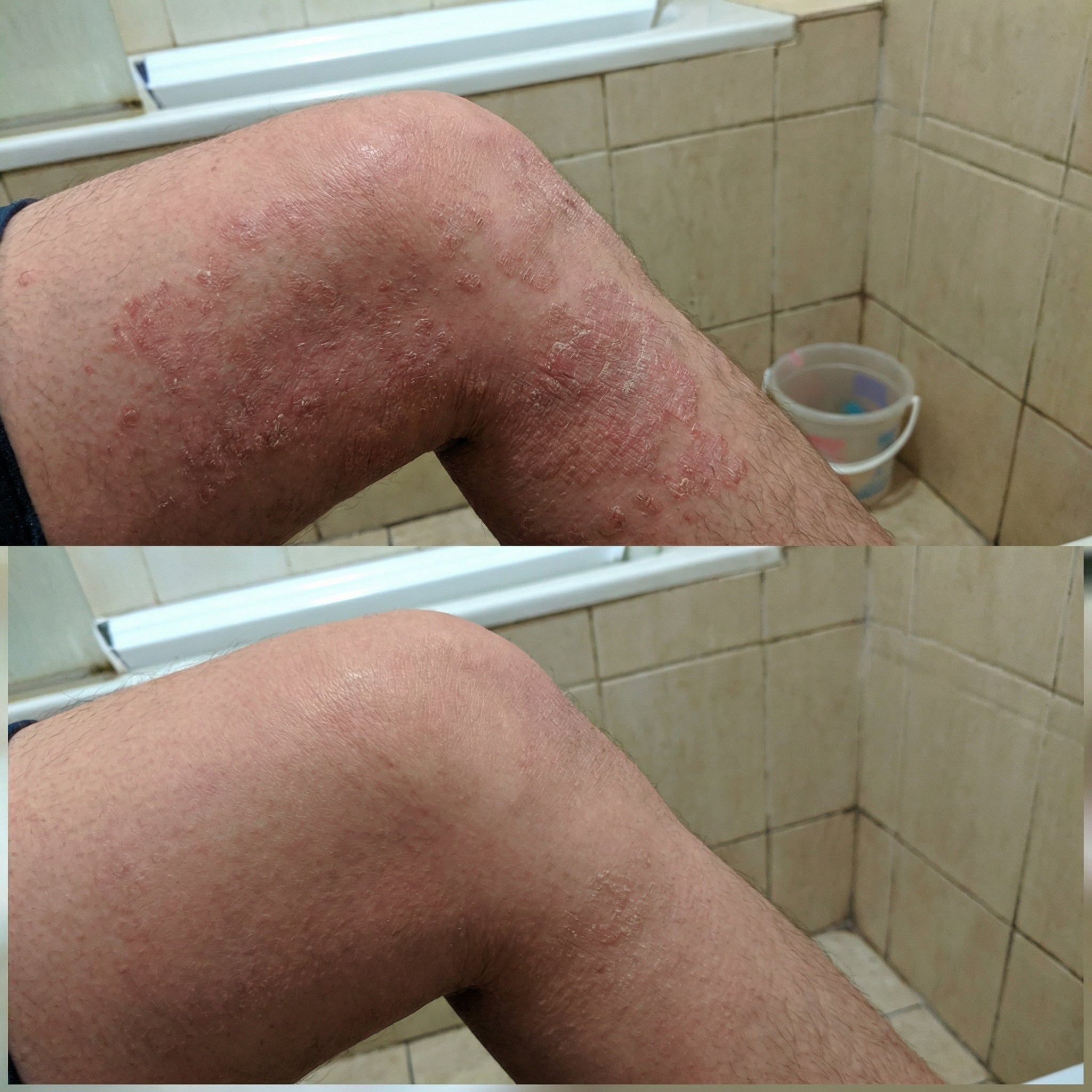 VedicDerm Sensitive Skin Bundle for Psoriasis, Eczema, Atopic Dermatitis