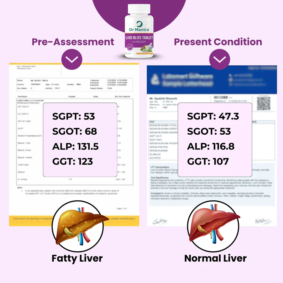 Dr Mantra Ayurvedic Livo Bliss Tablets for Fatty Liver| 30 Tablets
