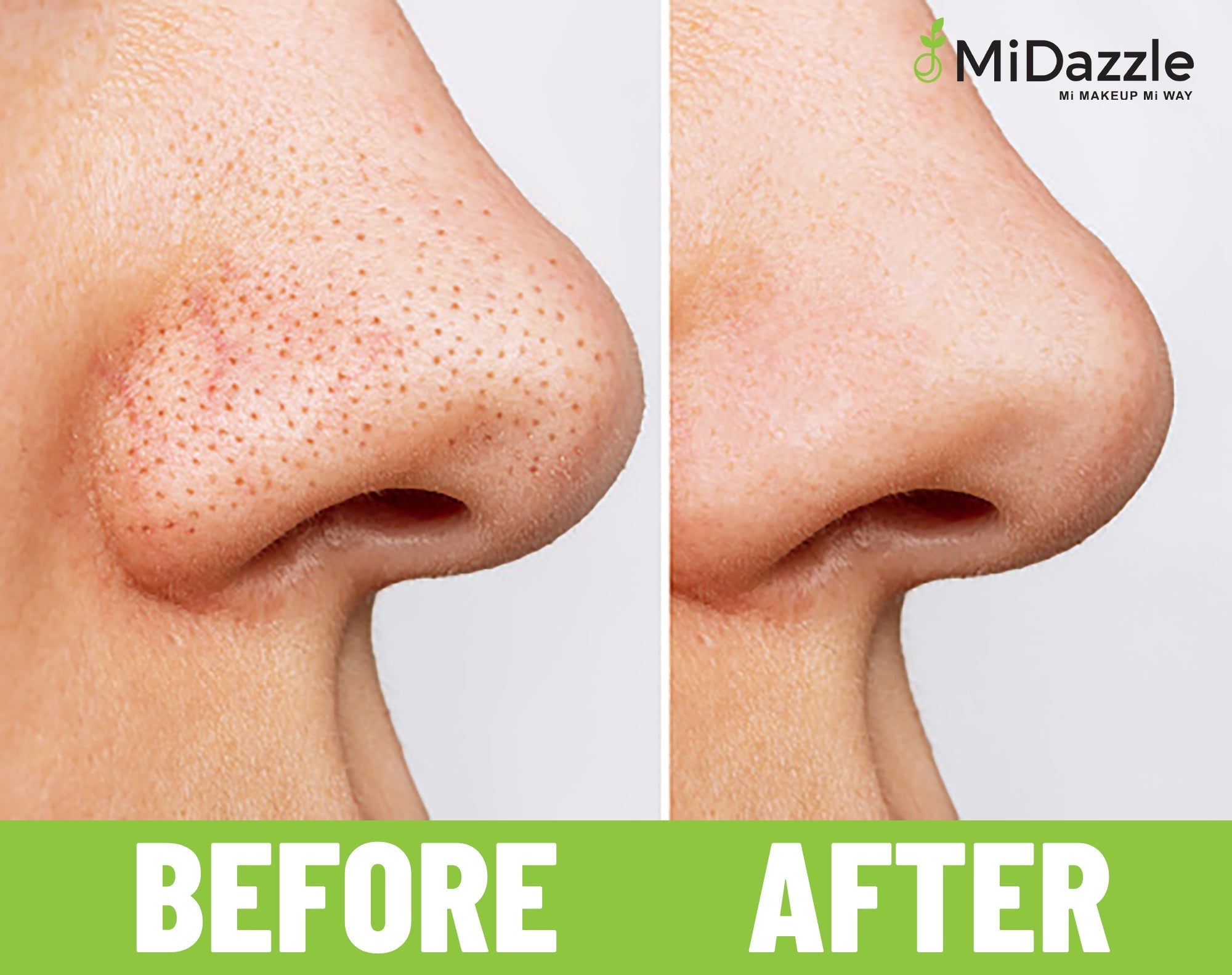 MiDazzle Black Head Remover MIBR3301