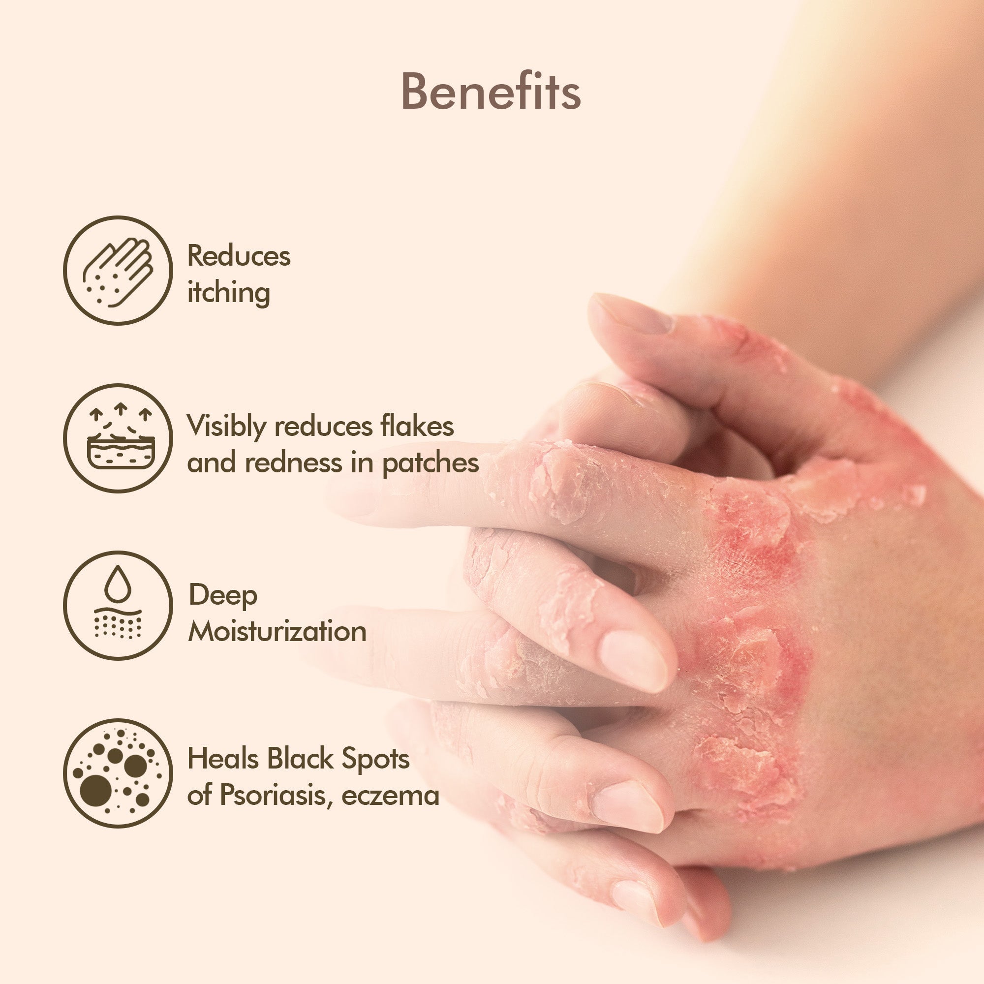 VedicDerm Oleander's Oil for Psoriasis, Eczema, and Atopic Dermatitis
