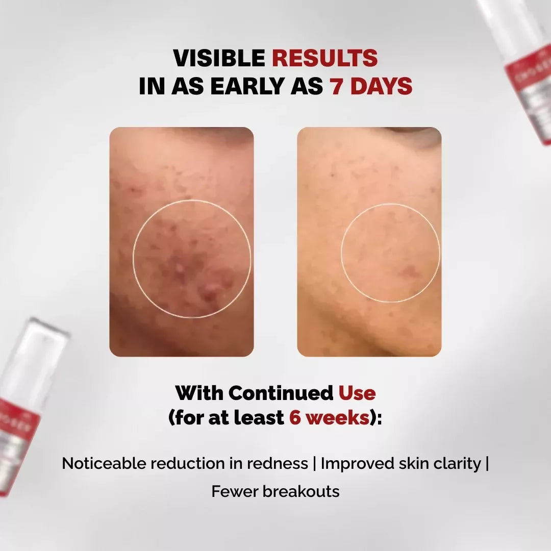 Chosen Re(D)Covery Serum Best Brightening Tranexamic Acid Serum