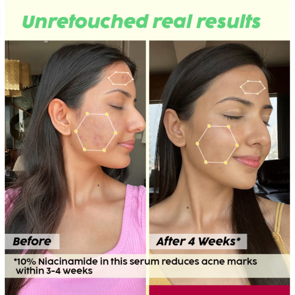 PLIX The Plant Fix 2% Acne Buster Moisturizer & 10% Niacinamide Serum