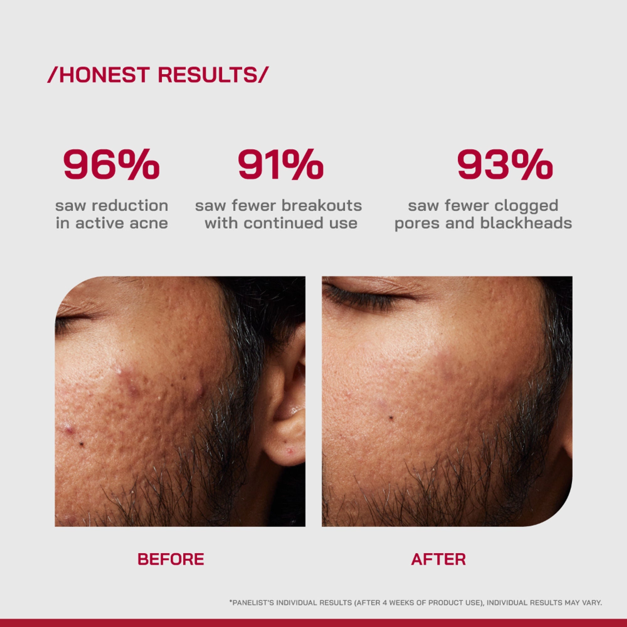 Proven Honest Derma (PHD) 2% Salicylic Acid Anti-Acne Serum