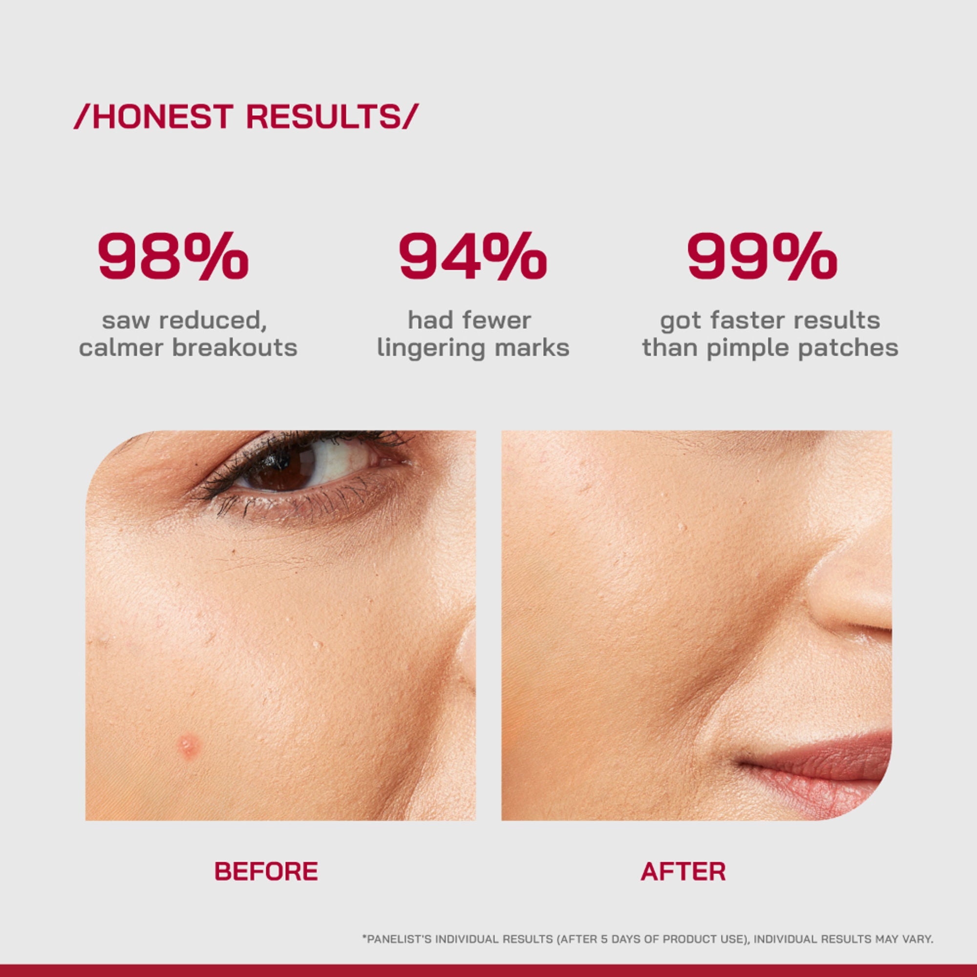 Proven Honest Derma (PHD) Salicylic Acid Acne Spot Gel