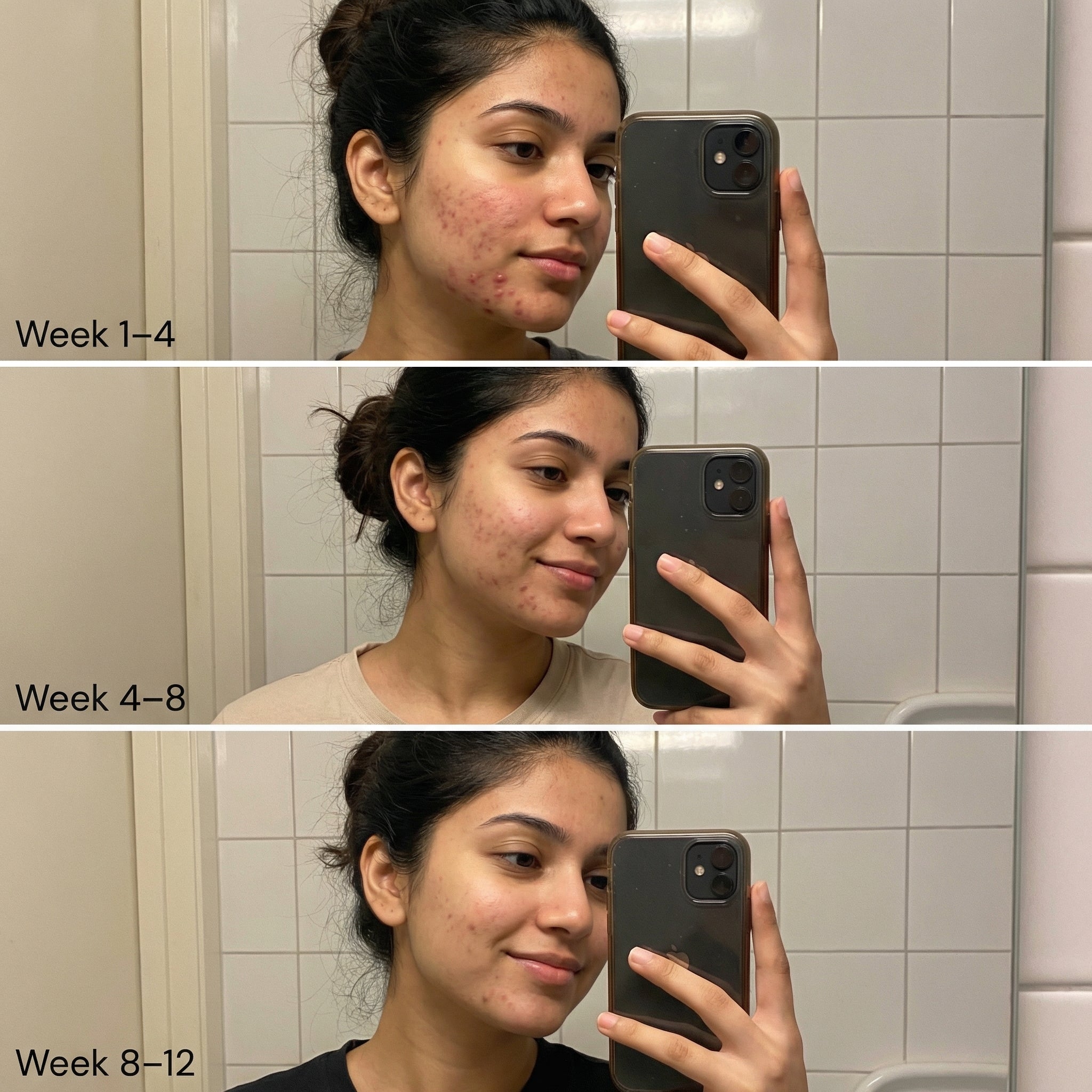 VedicDerm Nano Gold Acne Defence Cream with Turmeric and Nia-Cera-Peptide Complex™️