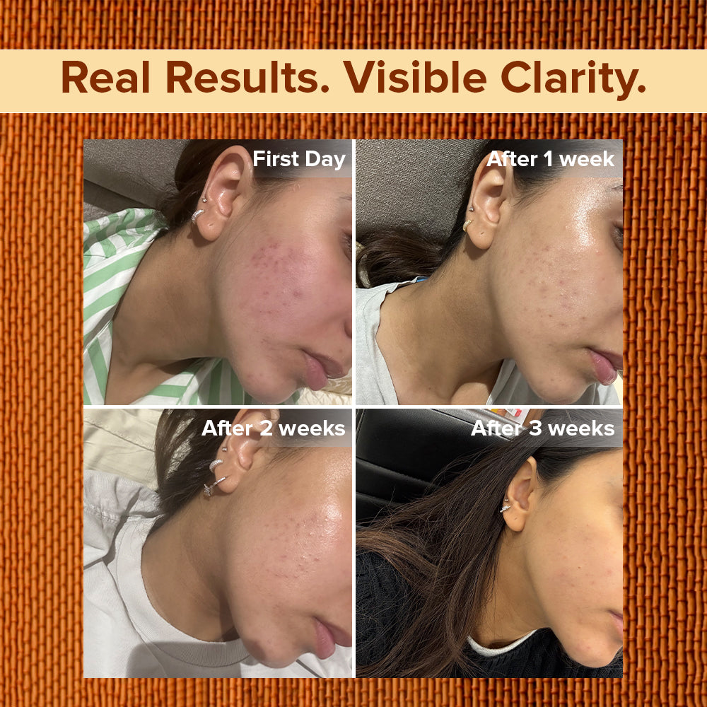 Cucumber Turmeric Anti Acne Skin Repair Face Gel - Image 3