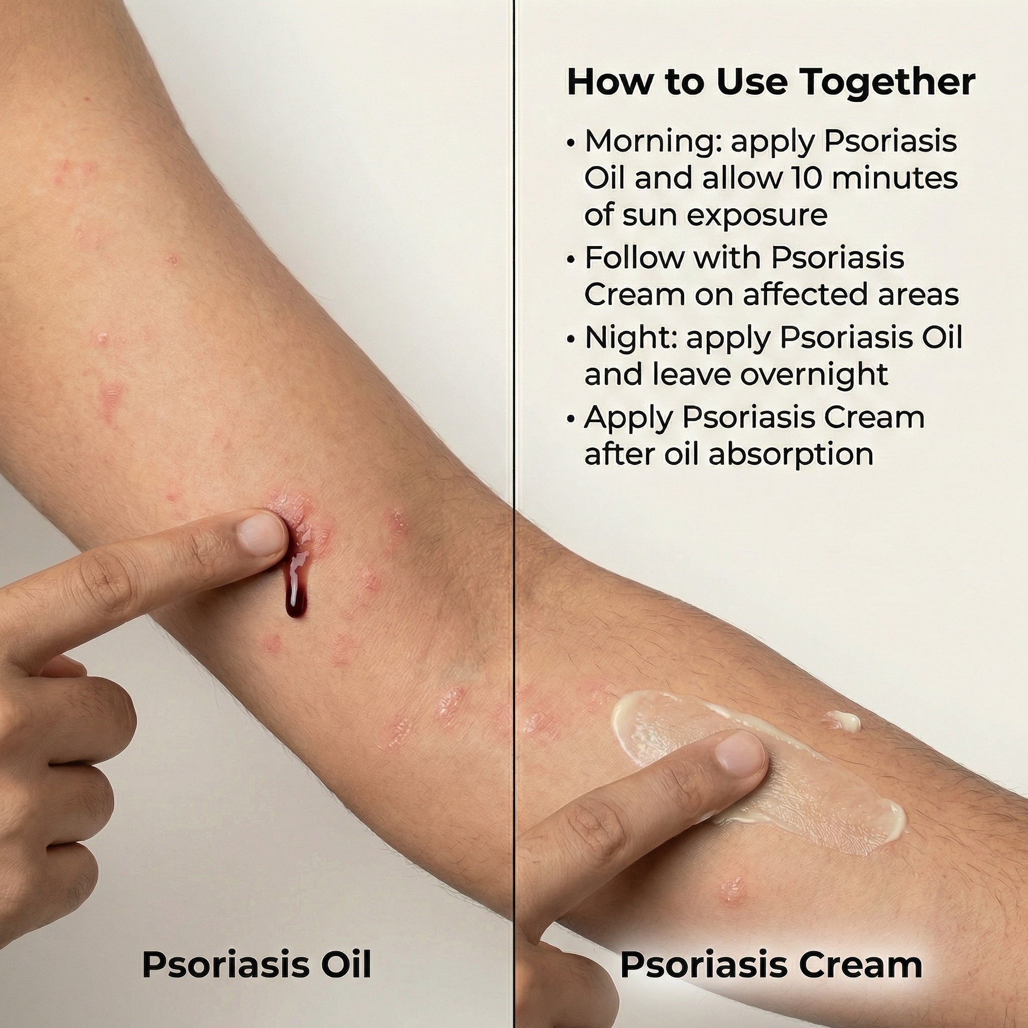 VedicDerm Sensitive Skin Bundle for Psoriasis, Eczema, Atopic Dermatitis