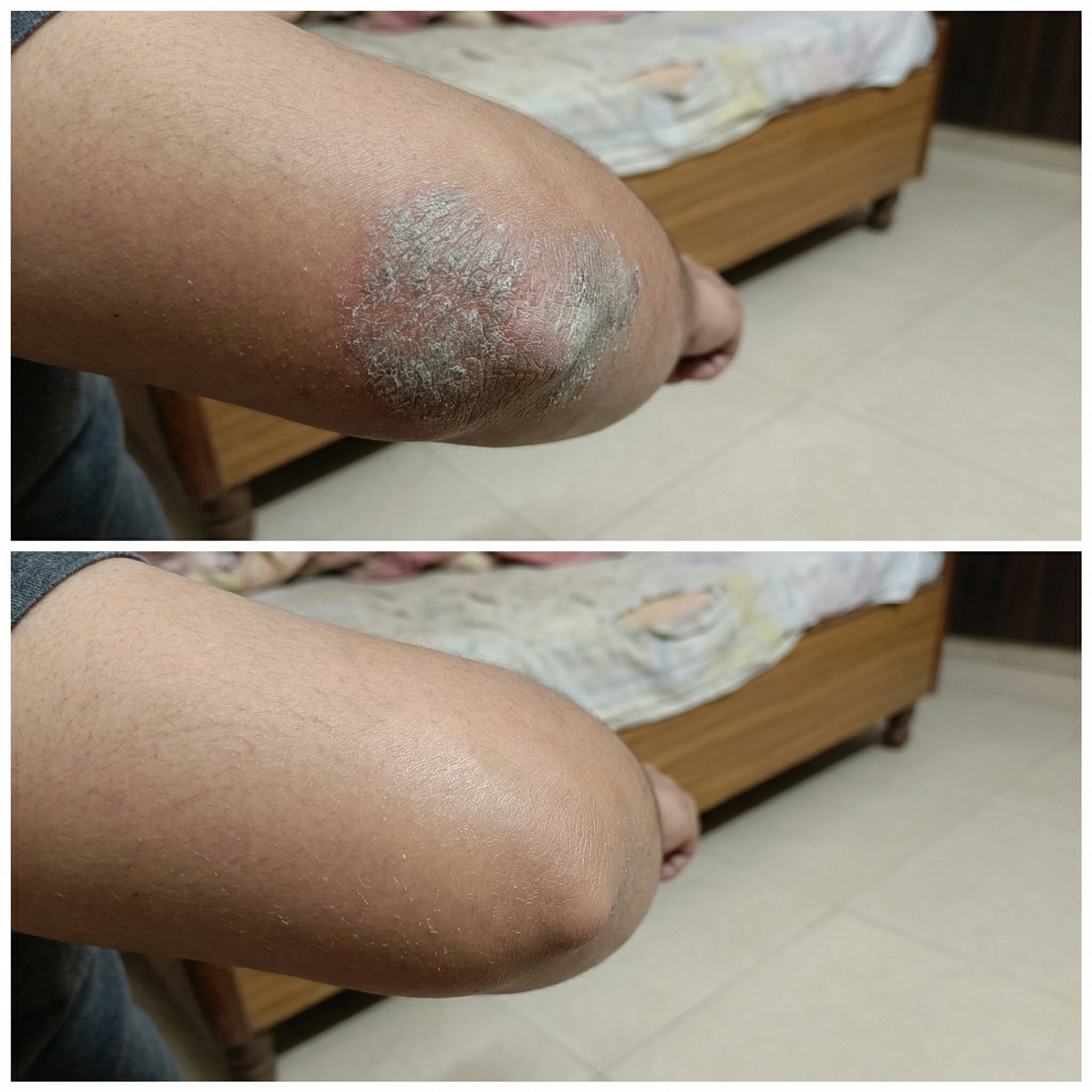 VedicDerm Sensitive Skin Bundle for Psoriasis, Eczema, Atopic Dermatitis