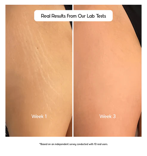 Cos-IQ Stretch Mark Removal Roll-On Serum